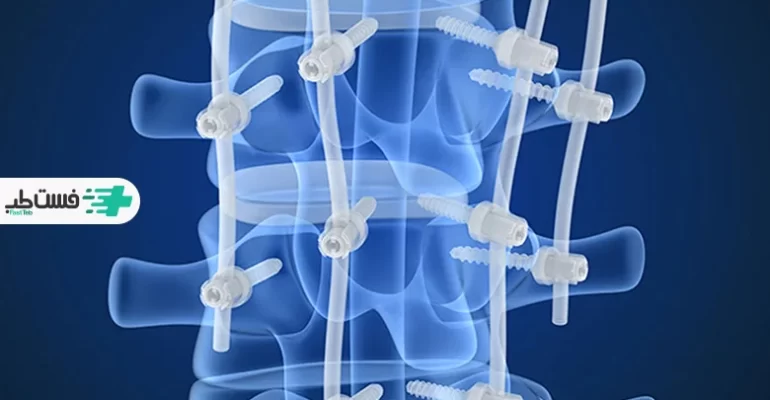 یکی از خطرات عمل تنگی کانال نخاعی ایجاد آرتروز در اطراف محل جراحی است|فست طب
