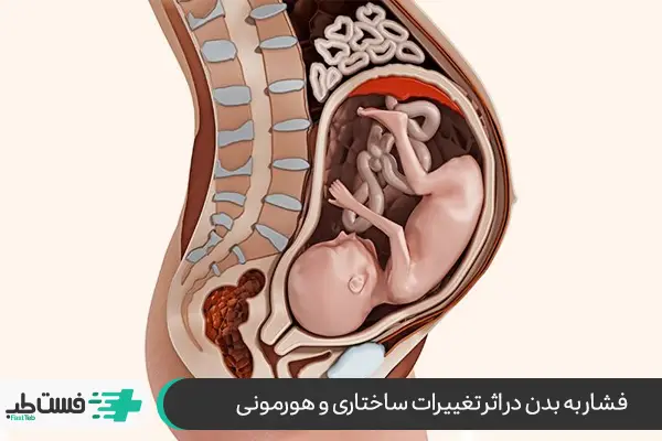 ایا دیسک کمر در بارداری خطرناک است|فست طب