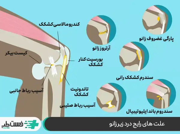 علت درد زیر زانو سمت چپ چیست و با چه علائمی همراه است|فست طب