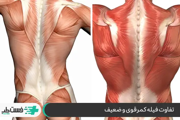 ضعف عضلات حامی کمر: علت درد در ناحیه گودی کمر|فست طب