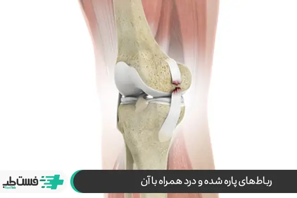آسیب رباط جانبی داخلی عاملی برای علت درد کنار زانو|فست طب