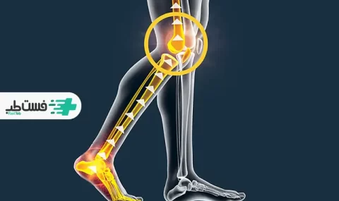 بررسی علت درد کفف پا تا زانو|فست طب
