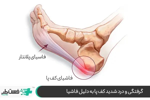 فاشیای کف پا؛ علت درد کف پای چپ در زنان|فست طب