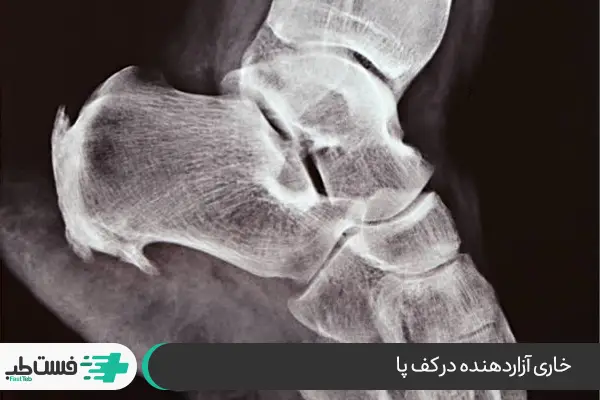 خار پاشنه؛ علت درد کف پا تا زانو در حین راه رفتن|فست طب