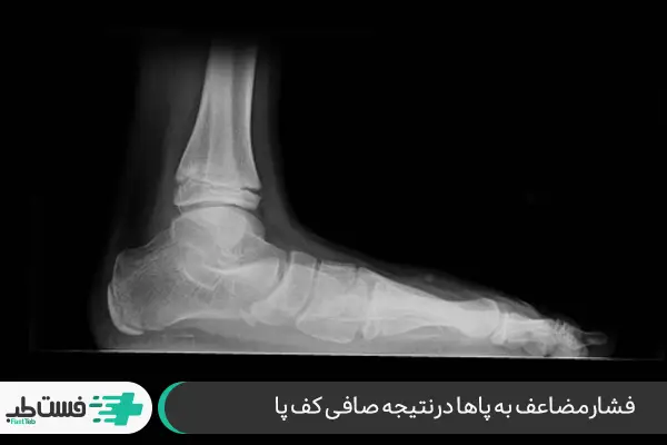 صافی کف پا؛ علت درد ران پا در زنان|فست طب