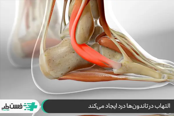 مهم‌ترین علل درد در قسمت بیرونی کف پا|فست طب
