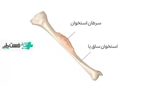 بررسی ارتباط درد ساق پا و سرطان|فست طب