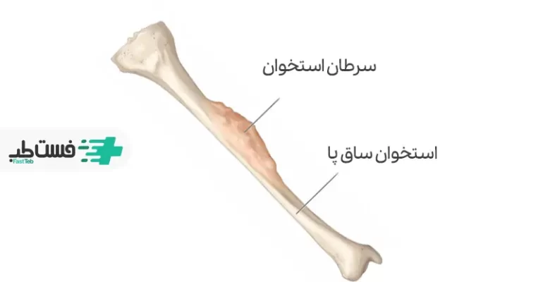 بررسی ارتباط درد ساق پا و سرطان|فست طب