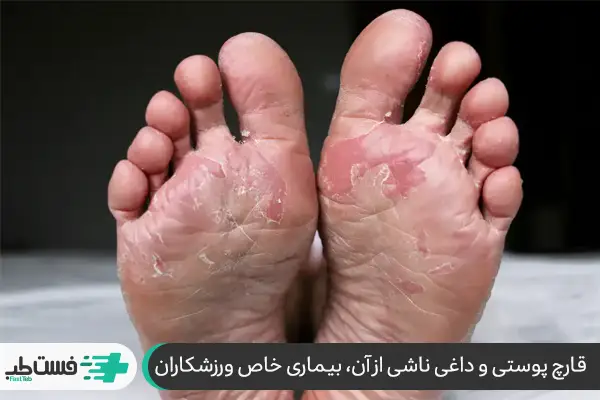 سندروم پای ورزشکار، یک عفونت قارچی پوستی است که معمولاً از بین انگشتان پا شروع می‌شود|فست طب