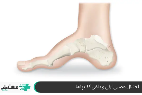 بیماری شارکوت- ماری- توث، باعث آسیب عصبی به‌ویژه در بازوها و پاها می‌شود|فست طب