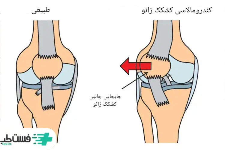 نرمی غضروف کشکک زانو