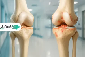 معرفی بهترین روش درمان آرتروز زانو