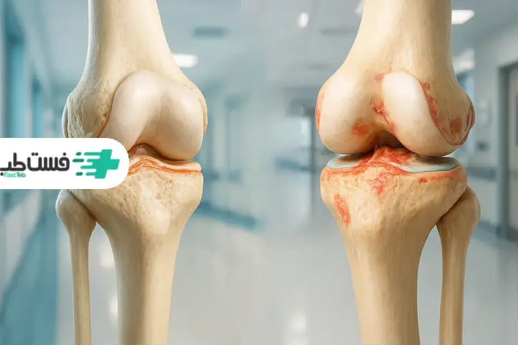 معرفی بهترین روش درمان آرتروز زانو