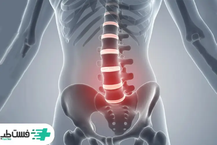 علائم دیسک کمر خطرناک