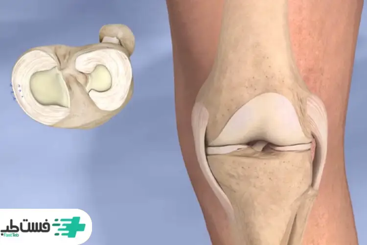 مینیسک زانو