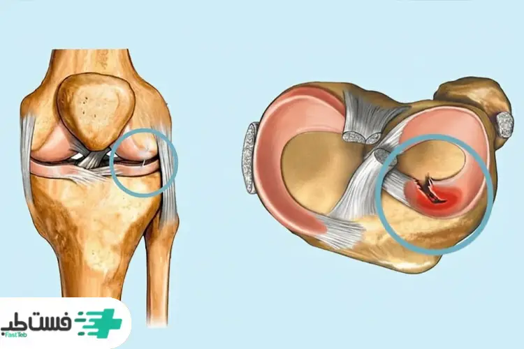 پارگی مینیسک زانو تصویر