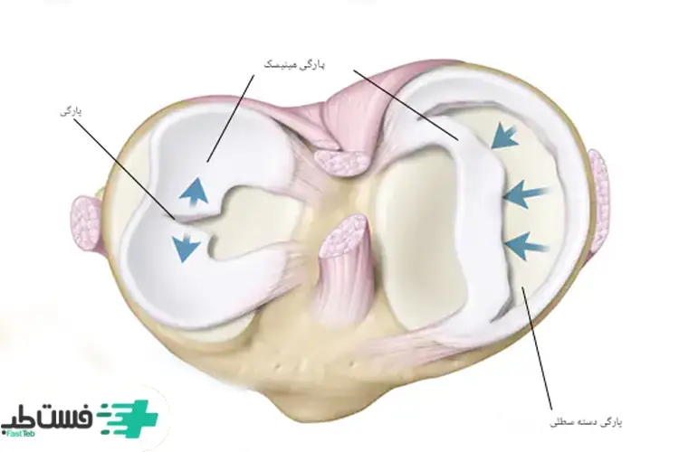پارگی مینیسک زانو