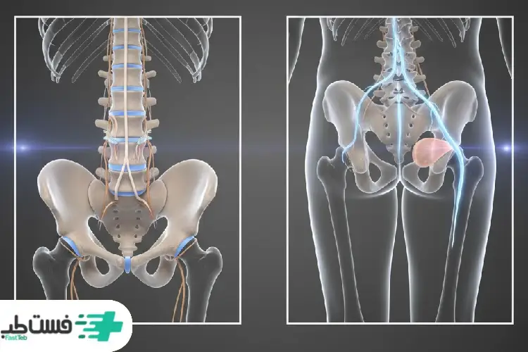 تفاوت دیسک کمر و سیاتیک