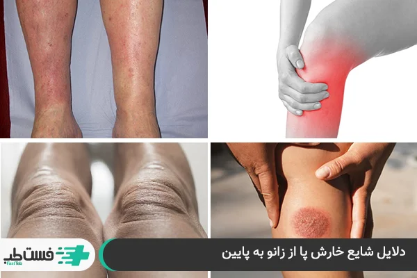 دلایل شایع خارش پا از زانو به پایین| فست طب